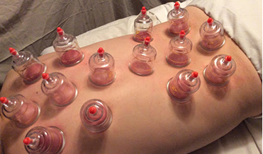 History, Development And Modern Use Of Fire Cupping Therapy