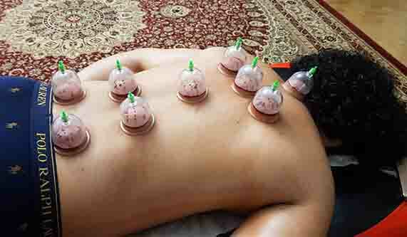 What Is Cupping Therapy? What Are the Benefits? – D2D Therapies