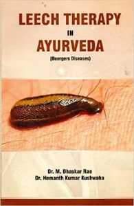 Leech Therapy in Ayurveda (Buergers Diseases)